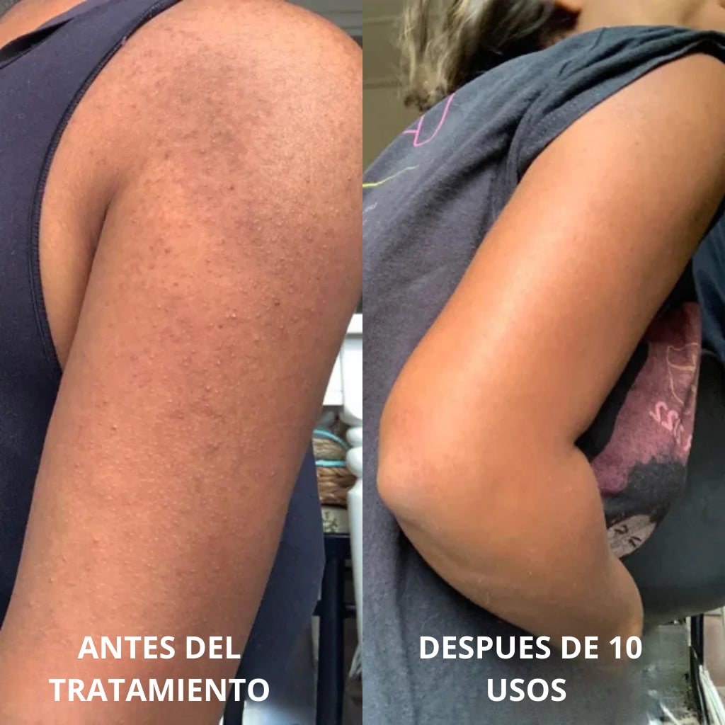 Tratamiento Anti Piel de Fresa Complejo Avanzado de Triple Ácido