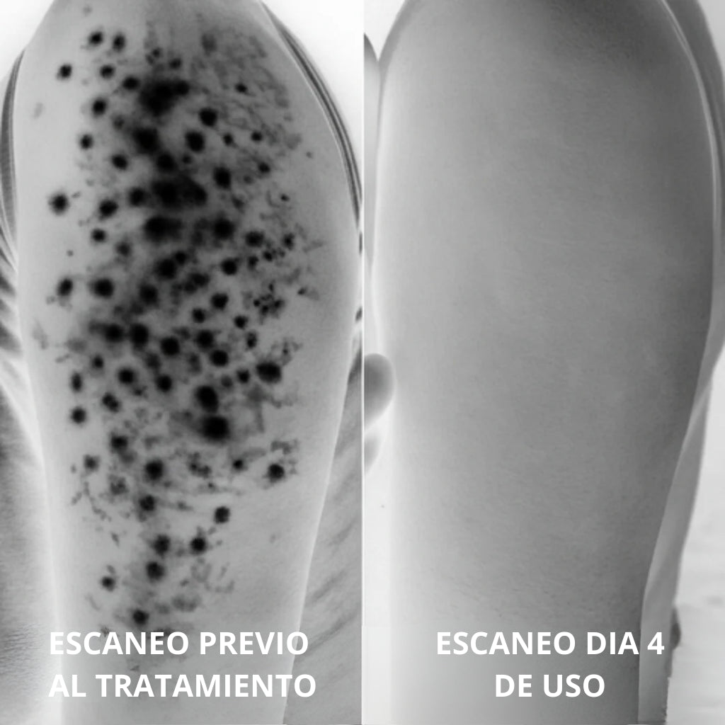 Tratamiento Anti Piel de Fresa Complejo Avanzado de Triple Ácido