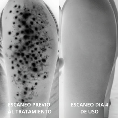 Tratamiento Anti Piel de Fresa Complejo Avanzado de Triple Ácido