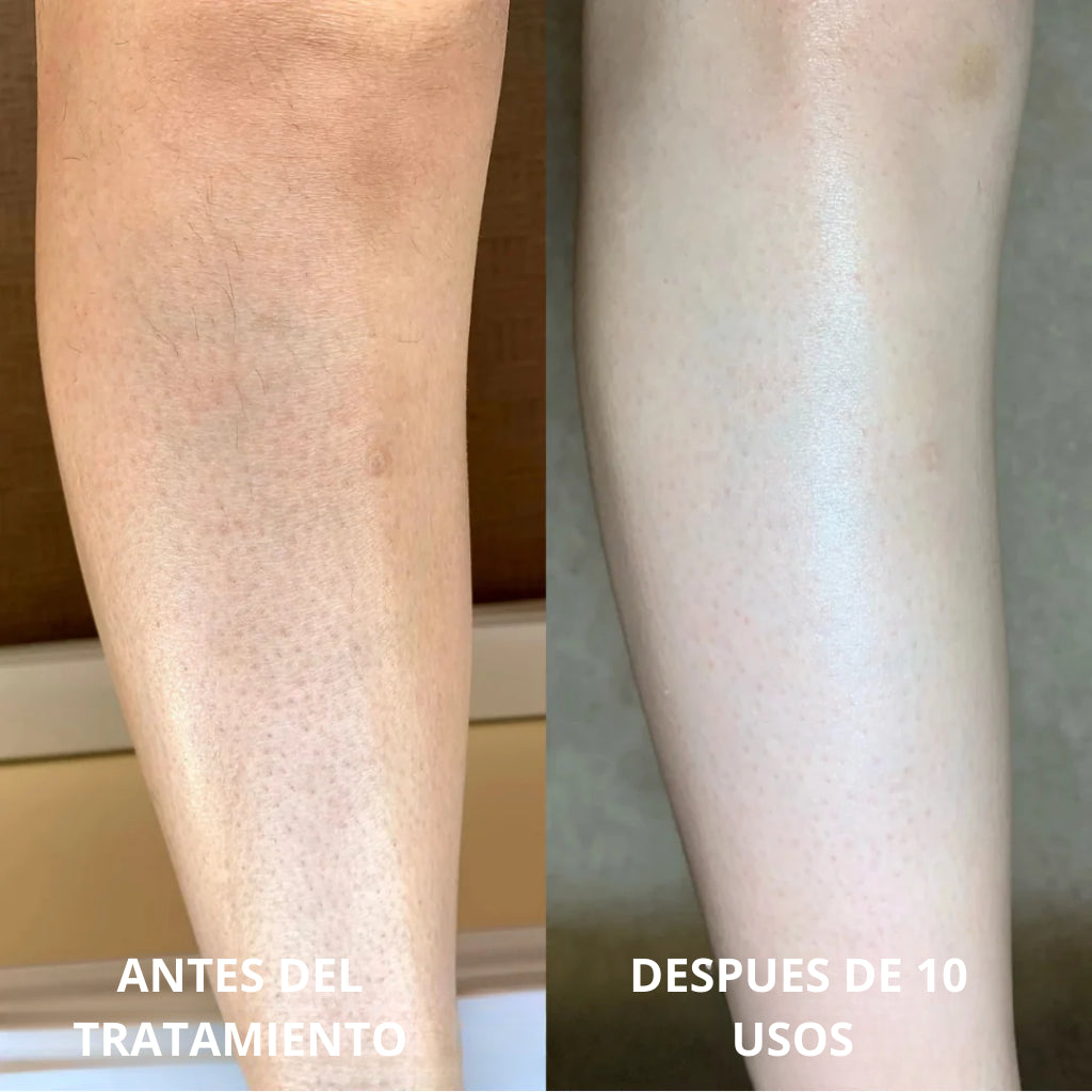 Tratamiento Anti Piel de Fresa Complejo Avanzado de Triple Ácido