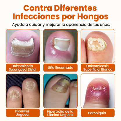 FungiBee™ –Aerosol Cuidado Intensivo para Uñas Maltratadas